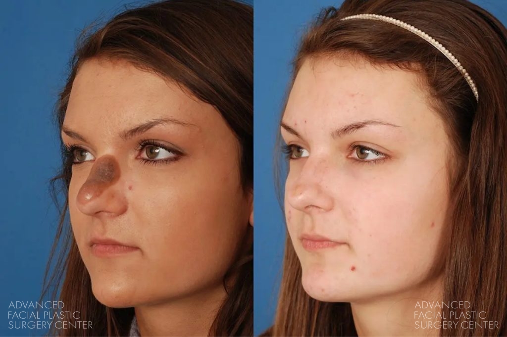2025 03 afps skin lesion removal patient 2