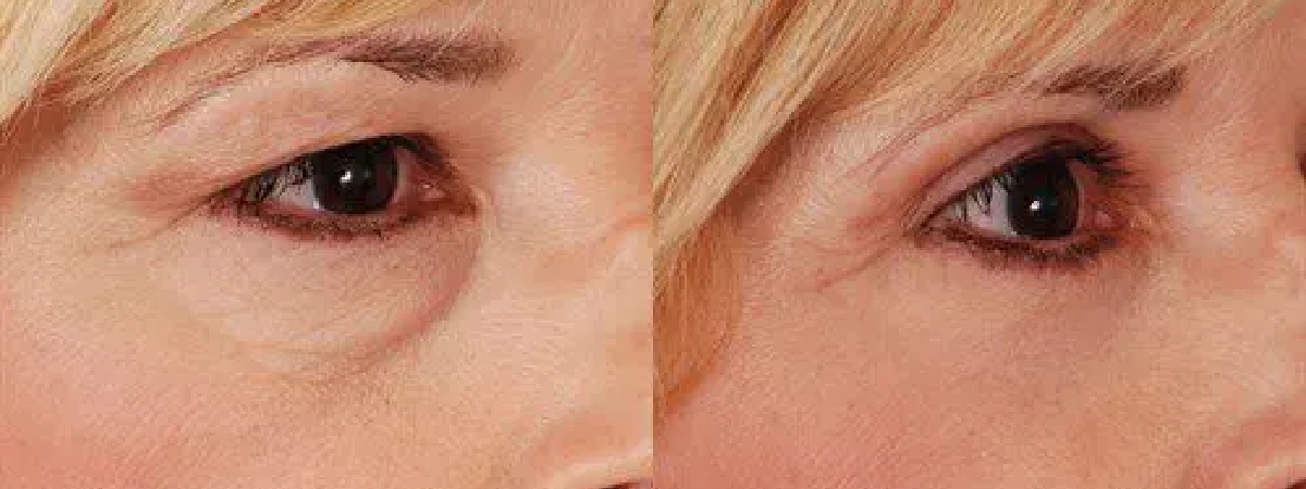2025 03 afps eyelid surgery patient 1 2025 03 afps eyelid surgery patient 1