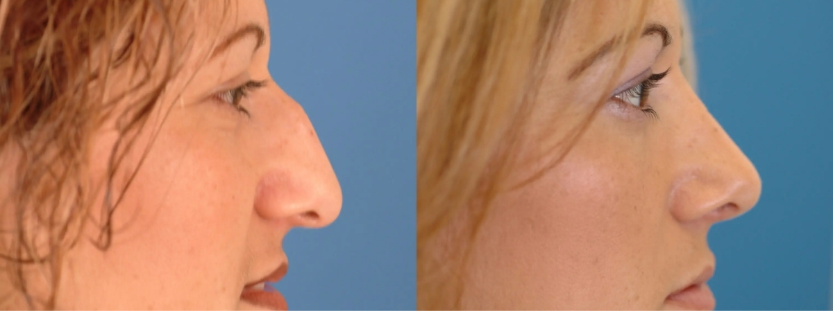 Afps bas rhinoplasty patient 2 Afps bas rhinoplasty patient 2