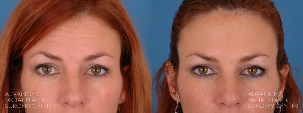 2025 02 afps botox patient 3 2025 02 afps botox patient 3