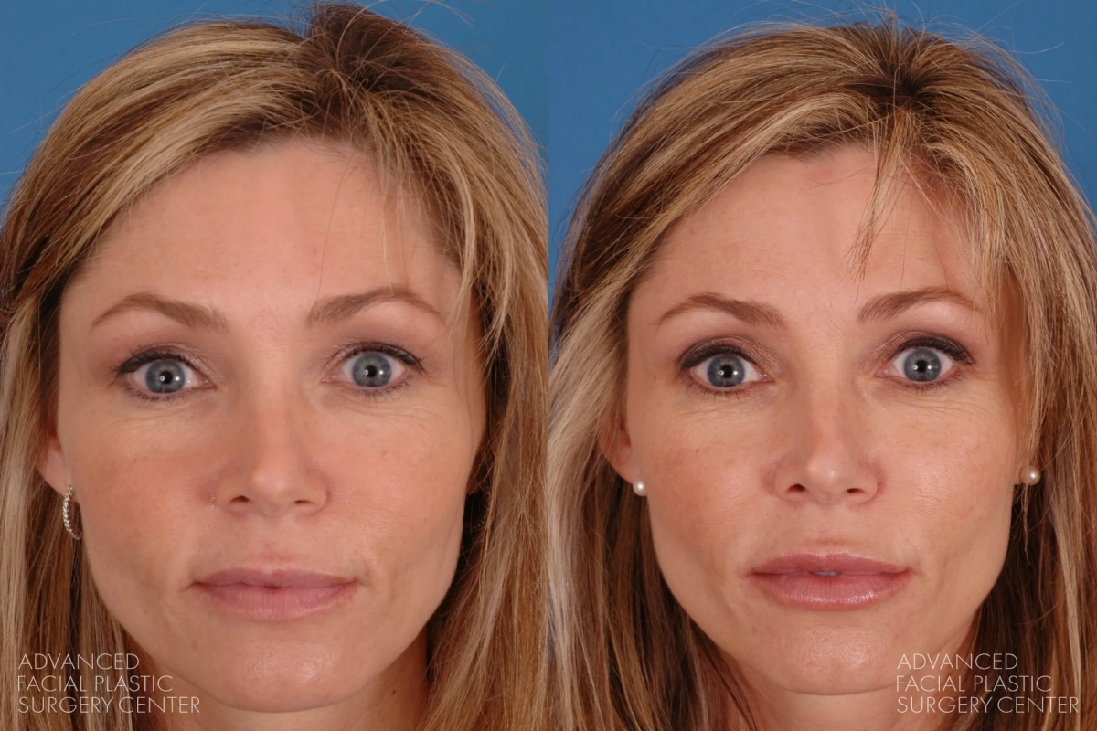 2025 02 afps injectable fillers patient 10 2025 02 afps injectable fillers patient 10