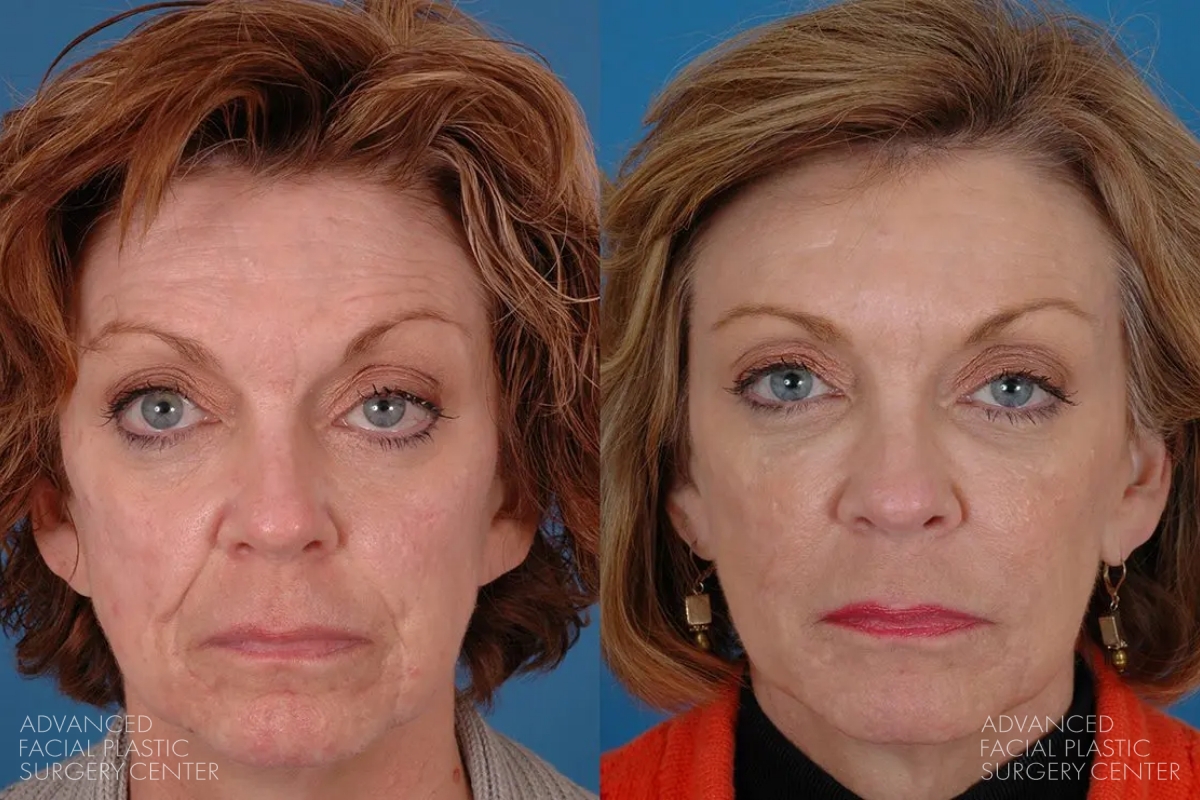 2025 02 afps sculptra patient 2 2025 02 afps sculptra patient 2