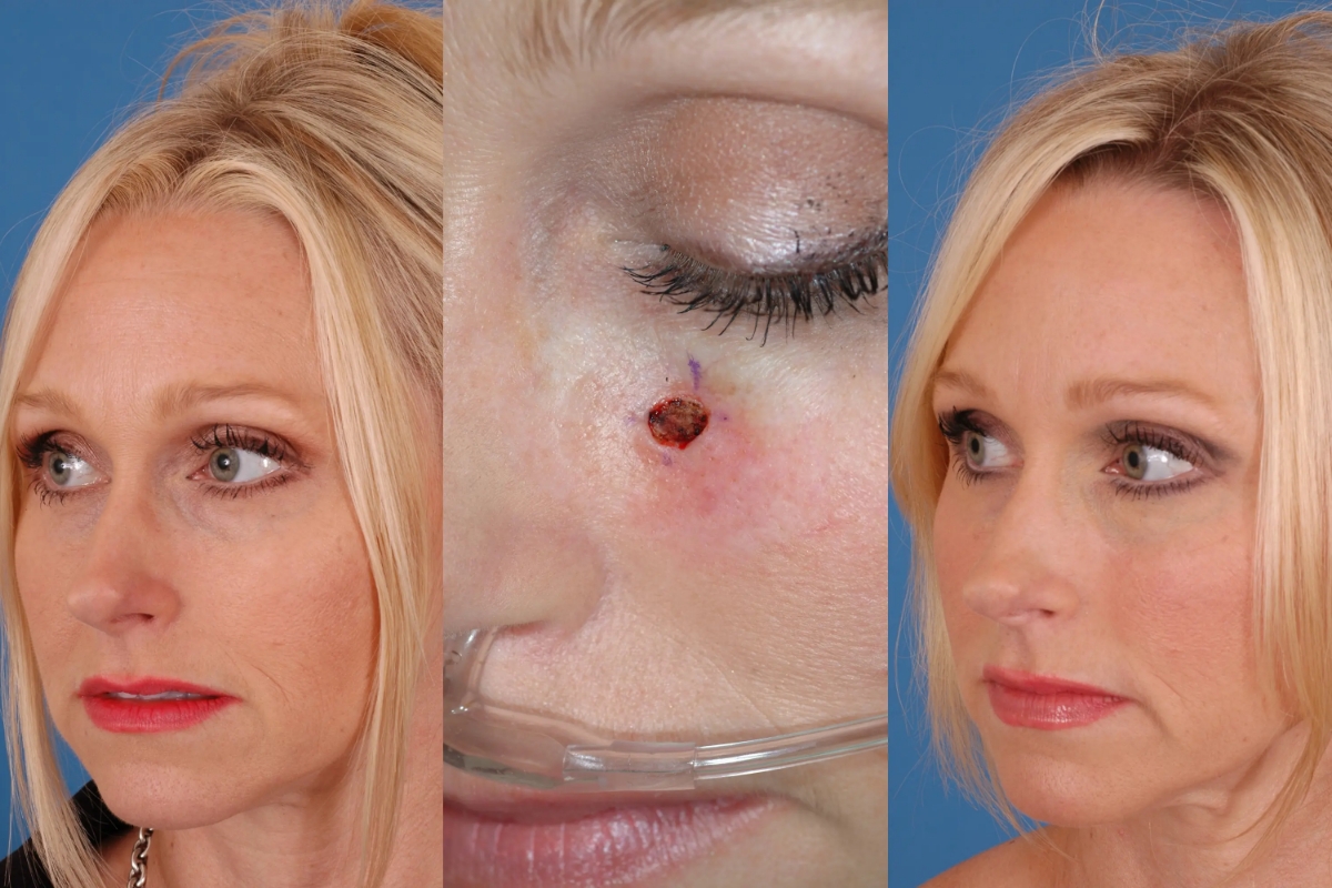 2025 03 afps bas skin cancer patient 3 2025 03 afps bas skin cancer patient 3
