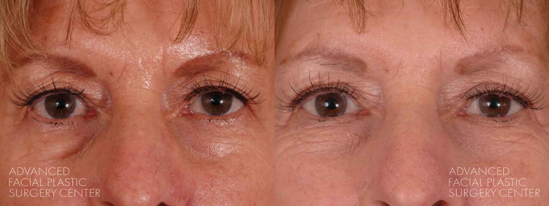 2025 03 afps brow lift patient 3 2025 03 afps brow lift patient 3