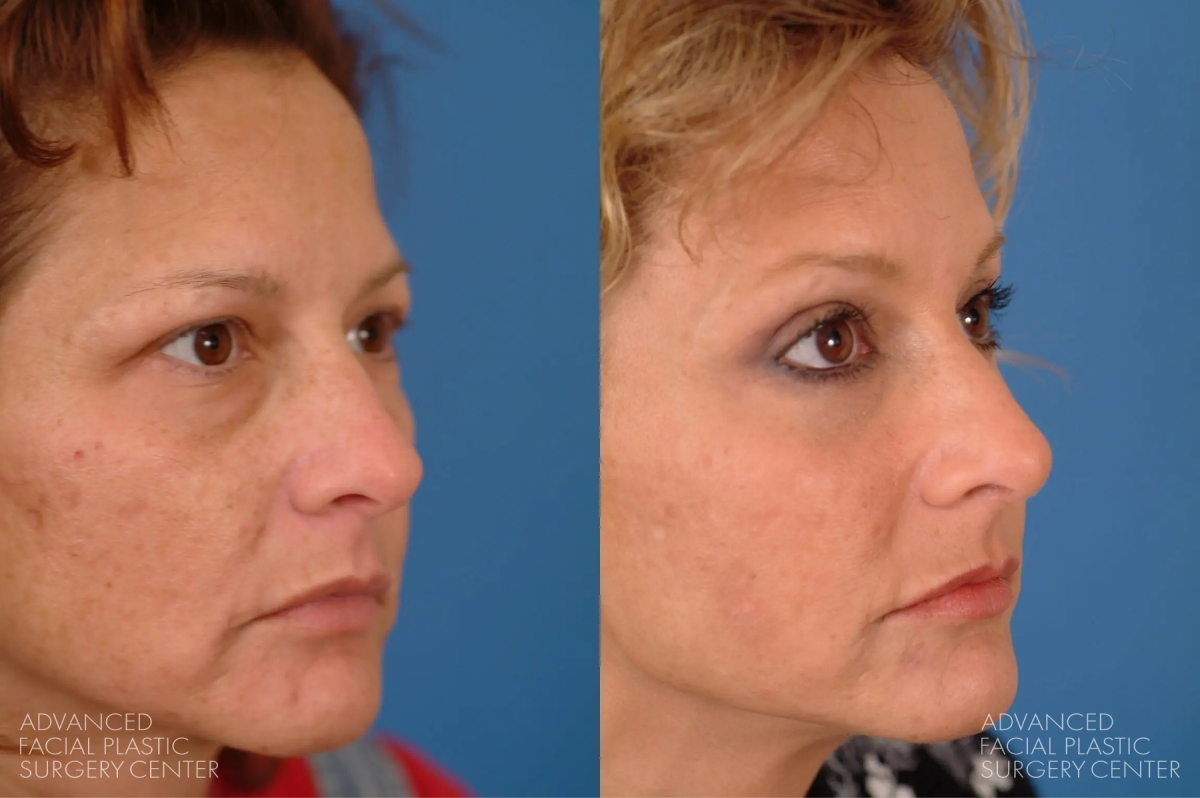 2025 03 afps midface lift patient 1 2025 03 afps midface lift patient 1