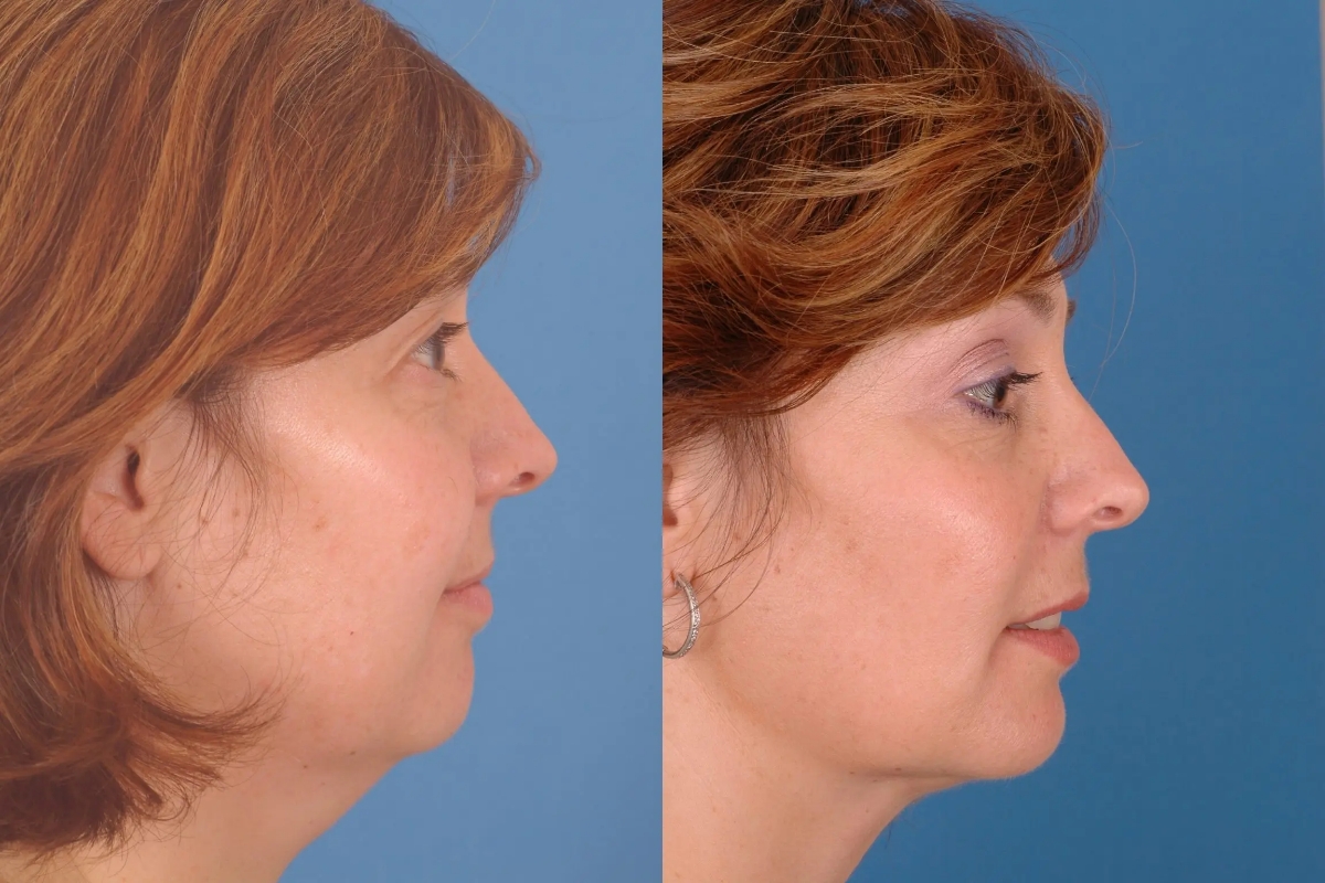 2025 03 afps neck lipo patient 1 2025 03 afps neck lipo patient 1