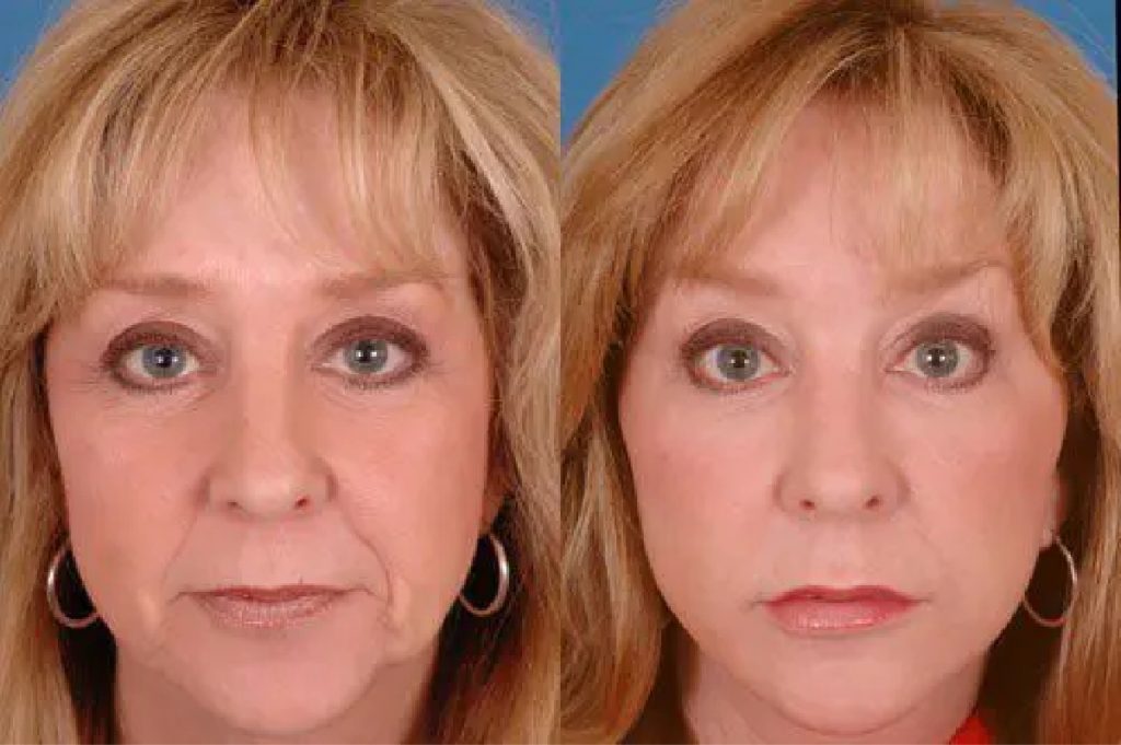 2025 03 afps revision facelift patient 1a 2025 03 afps revision facelift patient 1a