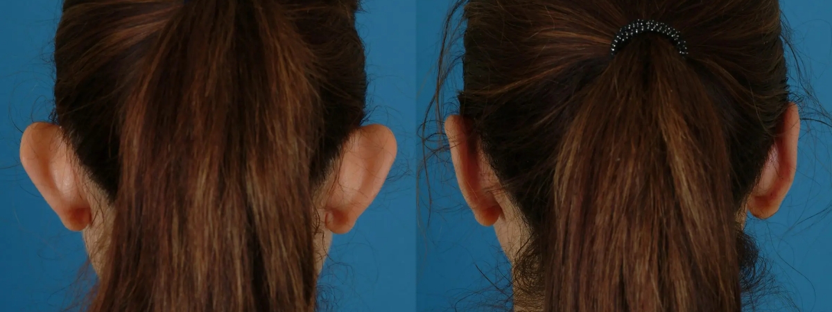 Afps bas ear reshaping patient 1 Afps bas ear reshaping patient 1