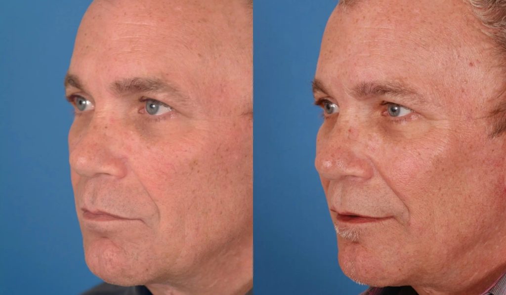 Afps bas facial implants patient 2 Afps bas facial implants patient 2