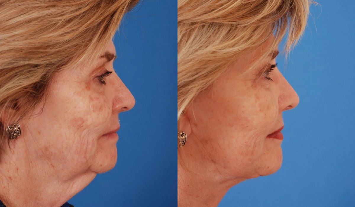 Afps bas necklift patient 1 Afps bas necklift patient 1